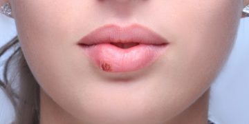 How to Get Rid of Fever Blisters