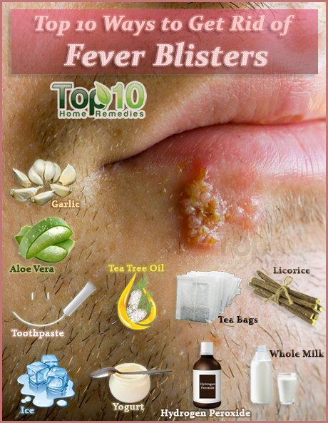 how to get rid of fever blisters.