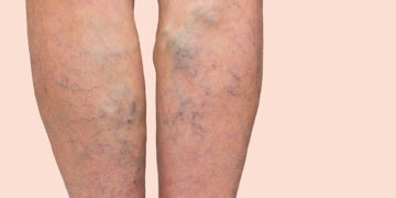 varicose veins