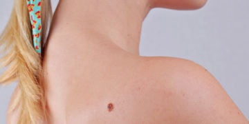 Home Remedies for moles