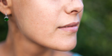 Home remedies for age spots