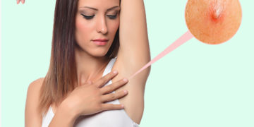 Home remedies for Ingrown Hair