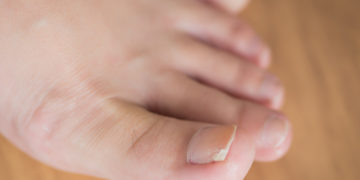 Home remedies for toenail fungus
