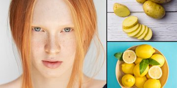 How to Get Rid of Hyperpigmentation