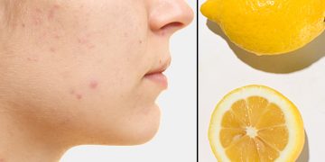 Home remedies for blemishes