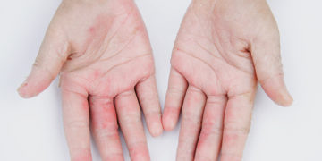Home remedies for fungal infections