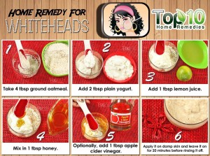 Whiteheads home remedy