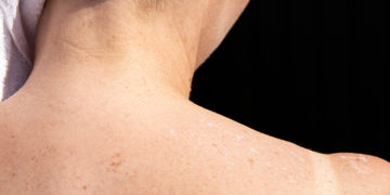 Home remedies for Peeling Skin