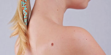 Home remedies for skin tags