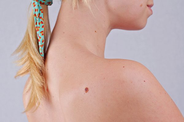 Home Remedies for Skin Tags