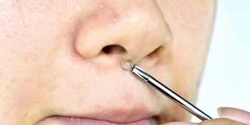 Home reemdies for whiteheads