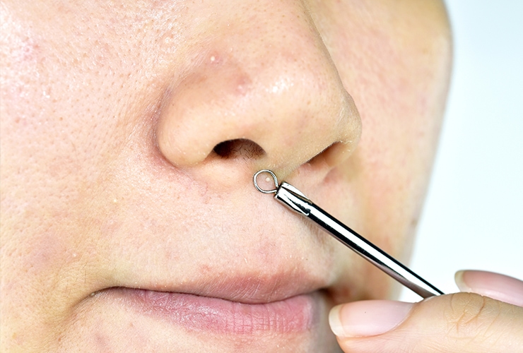 Home Remedies for Whiteheads Top 10 Home Remedies