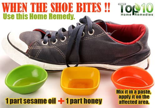 shoe bite home remedy