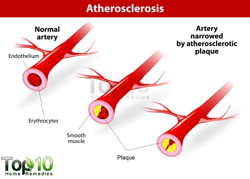 artherosclerosis heart disease