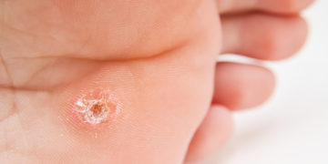 Home remedies for corns on feet