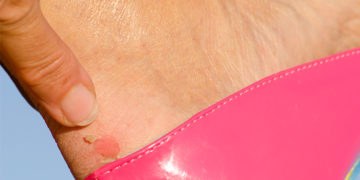 Home remedies for shoe bites