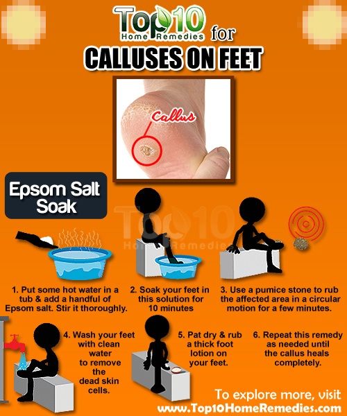 home remedies for calluses