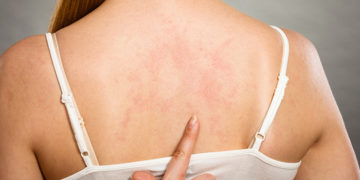 Home remedies for keratosis pilaris