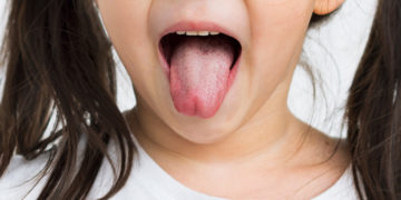 Home remedies for White Coated Tongue