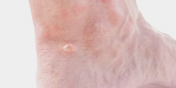 Home remedies for foot blisters