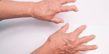 Home remedies for Rheumatoid Arthritis