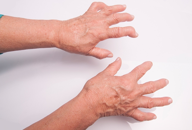 Home Remedies for Rheumatoid Arthritis Top 10 Home Remedies