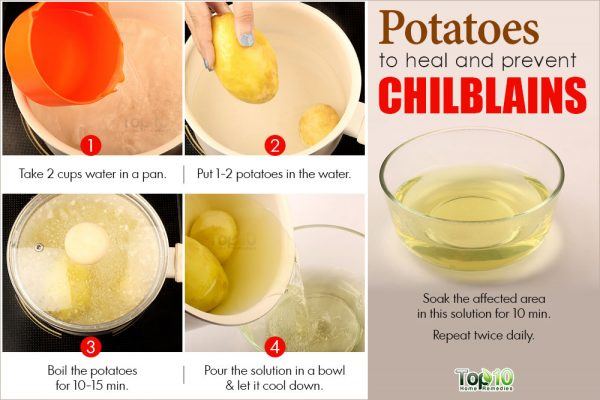 potatoes for chilblains