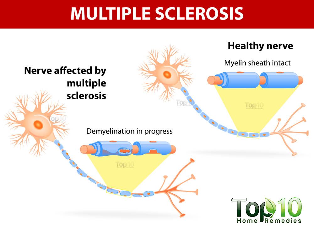 multiple sclerosis illustration