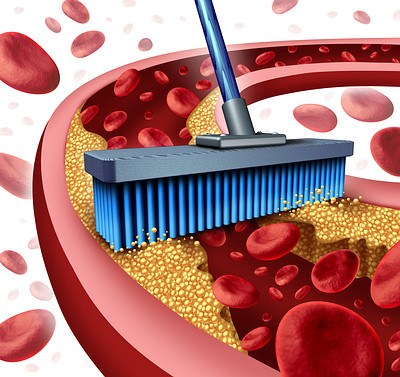 Cleaning Arteries-cholesterol-opt