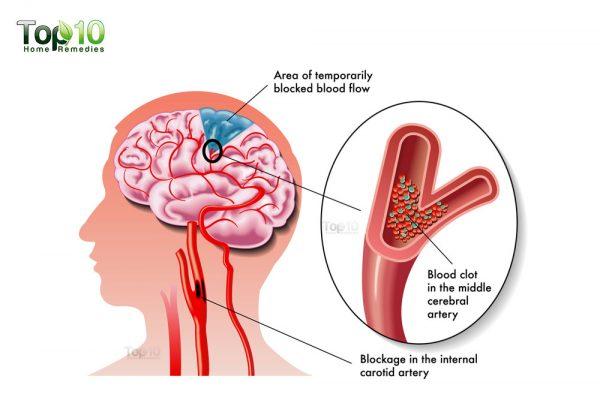 what happens in stroke