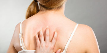 Home remedies for tinea versicolor