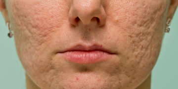 Home remedies for scar removal