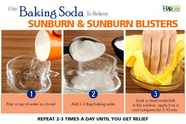 baking soda relieves sunburn and sunburn blisters