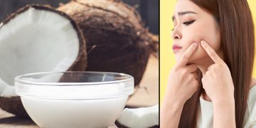 treat common summer problems with coconut oil
