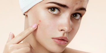 Home remedies for Cystic Acne