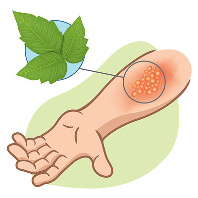 poison ivy rash
