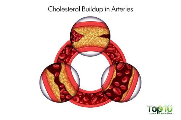 cholesterol buildup in arteries