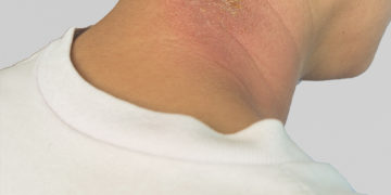 Home remedies for Staph Infections