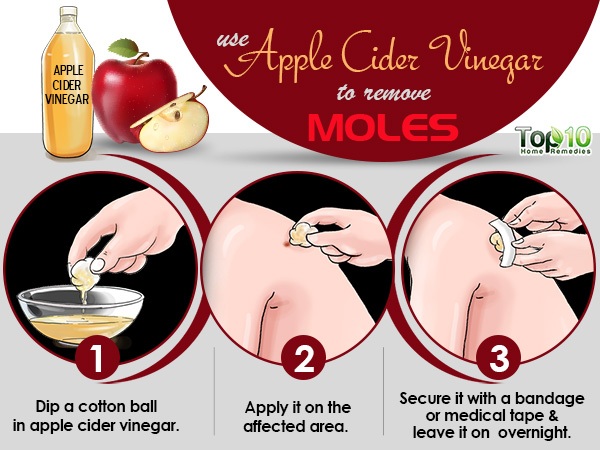 Apple cider vinegar remedy to get rid of a mole
