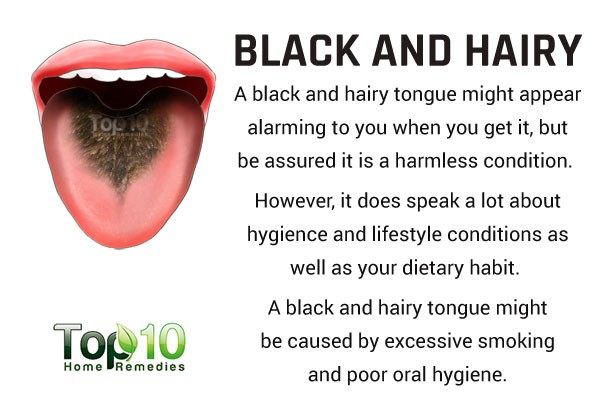 black and hairy tongue