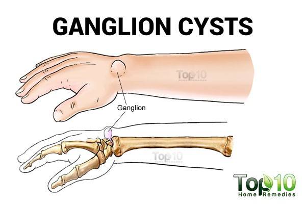 gangelion cysts diagram