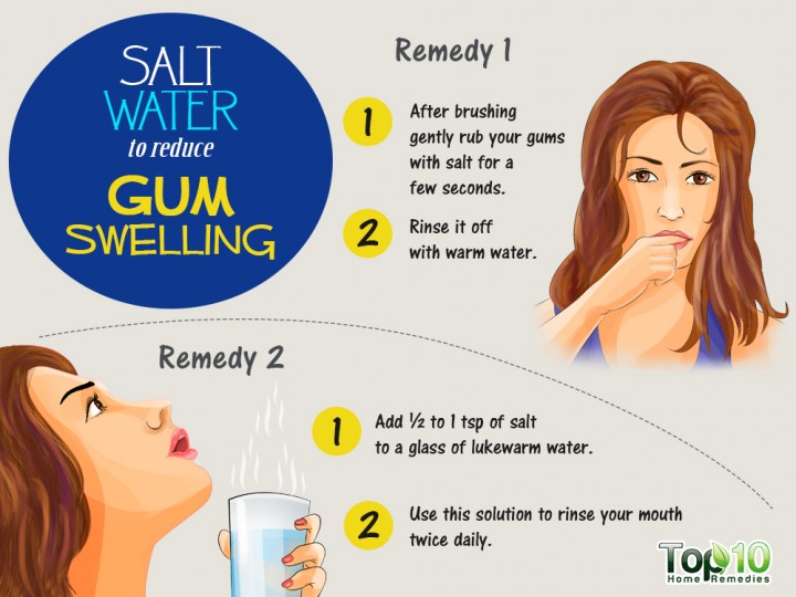 Home Remedies to Reduce Gum Swelling Top 10 Home Remedies