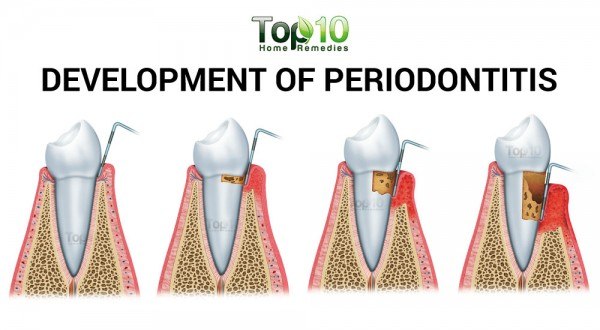 development of periodontitis