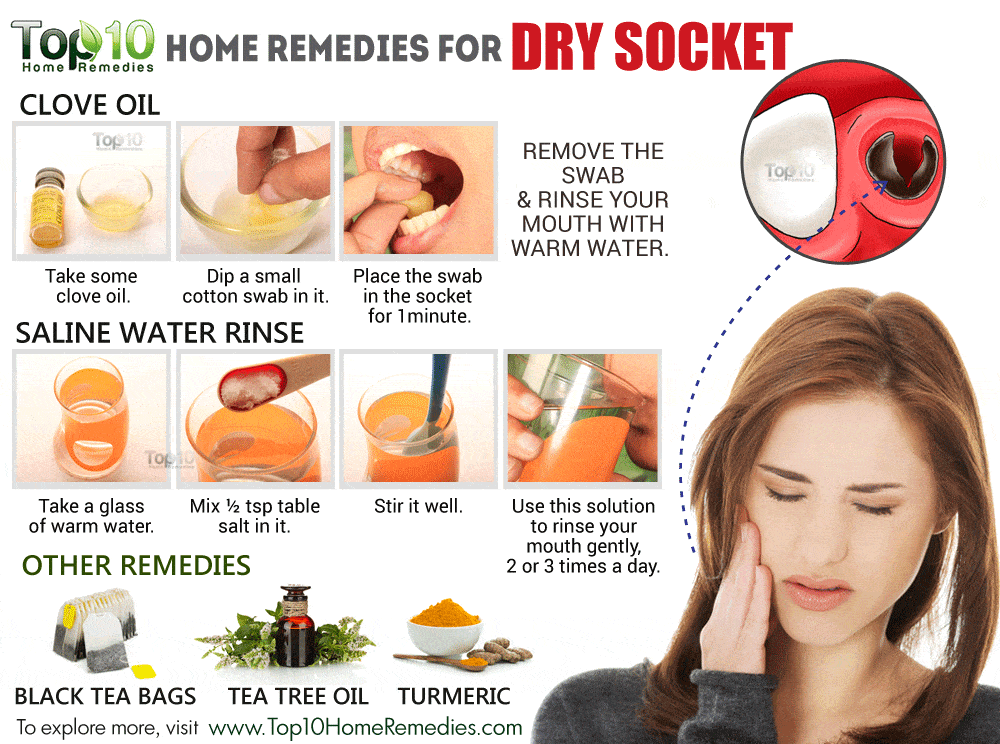 Home Remedies for Dry Socket | Top 10 Home Remedies