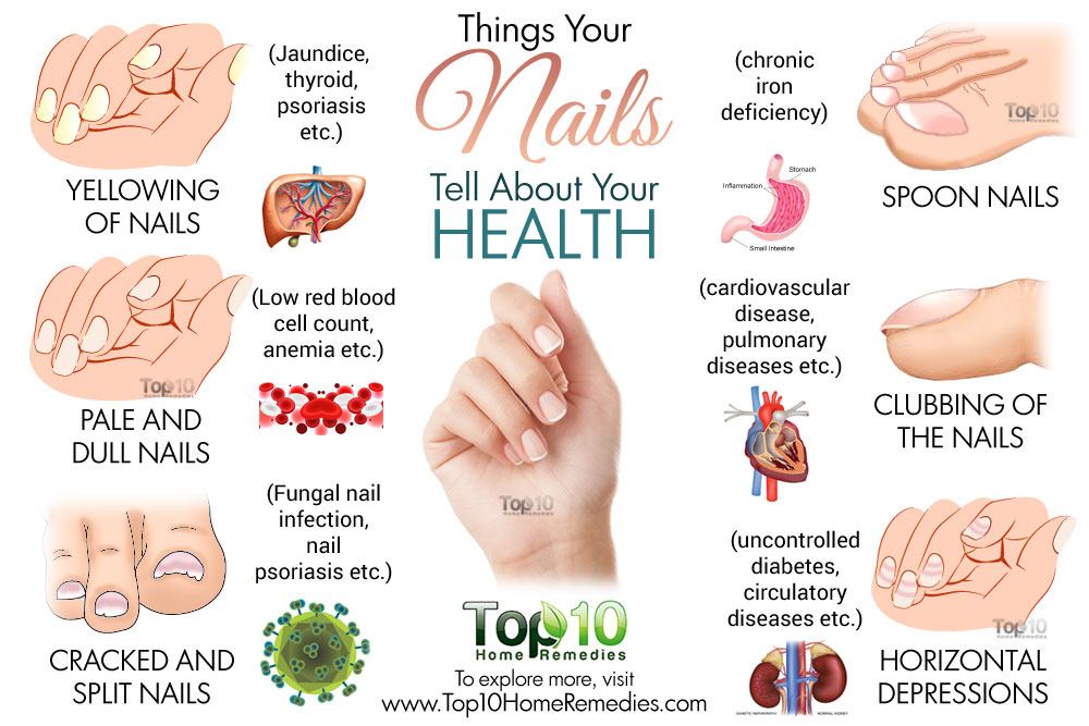 Signs of Health Problems Based on Nail Bed Color - wide 10