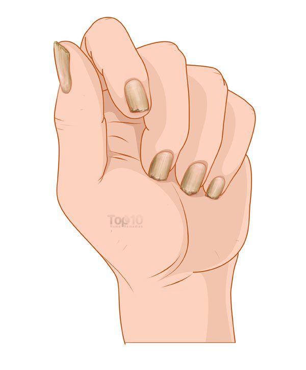 excessively thick nails