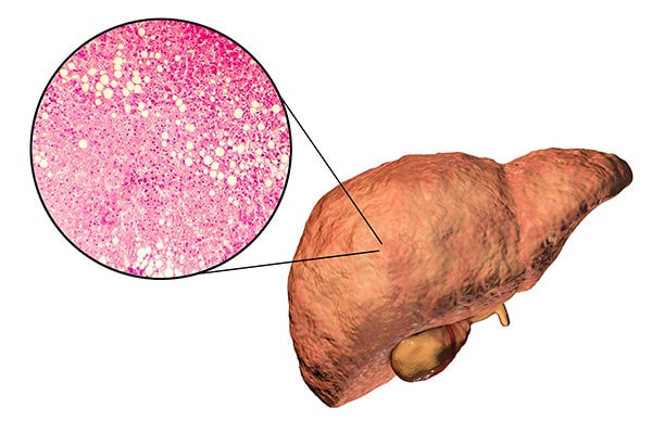 fatty lever disease