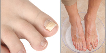 Home remedies for ingrown toenails