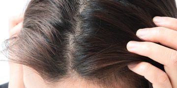 How to Get Rid of Scalp Acne