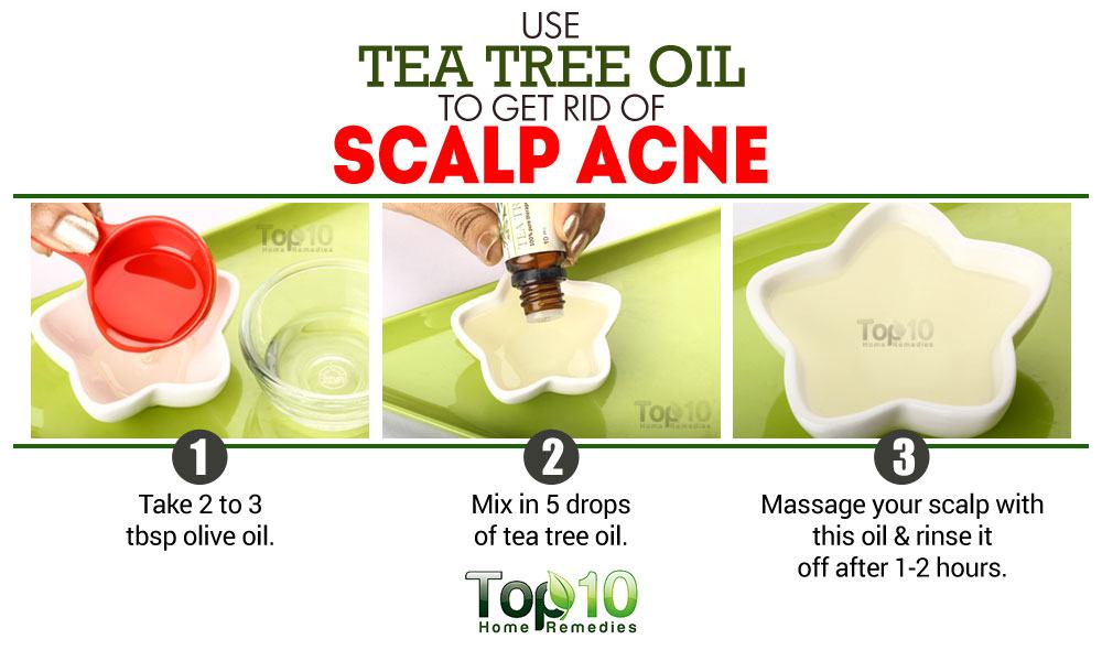Acne natural treatment scalp Natural Scalp